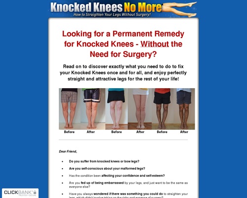 Knocked-Knees-No-More-How-to-Straighten-Your-Legs Knocked Knees No More - How to Straighten Your Legs Without Surgery!